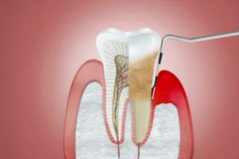 Periodontal Gum Disease Causes