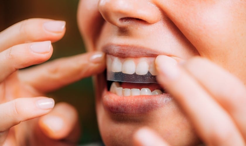 Cypress Dentist Patrick Vuong Explains Should You Brush Your Teeth After Using Whitening Strips