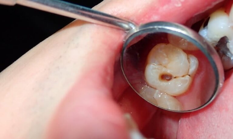 Dr Patrick Vuong Dentist In Katy Explains What Are Cavities