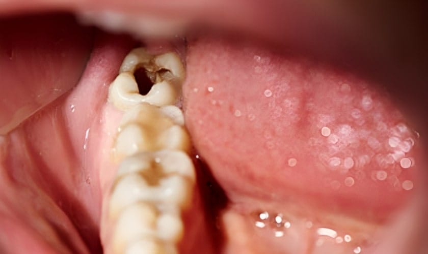 Prevention Of Front Tooth Cavities At Smile Avenue Family Dentistry Cypress