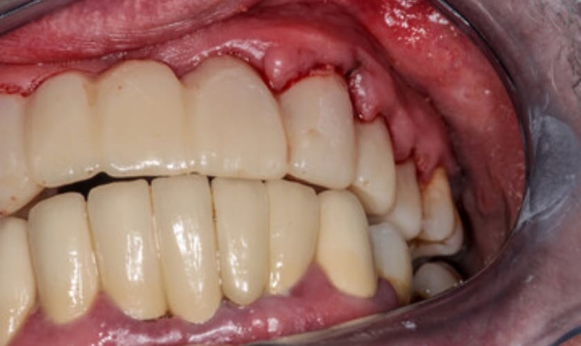 Smile Avenue Family Dentistry Cypress Cares For Tooth Abscess And Gum Abscess