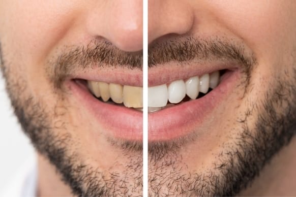 Can Yellow Teeth Become White Again