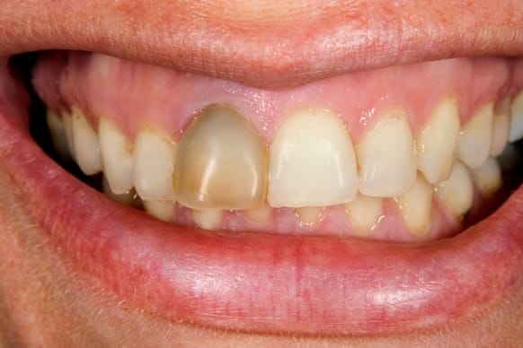 Common Signs And Symptoms Of A Dead Tooth
