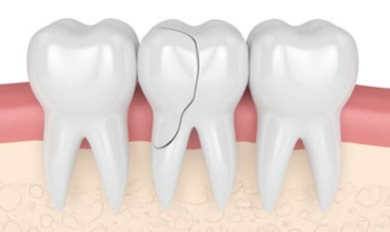 Cracked Tooth Fractured Tooth Syndrome