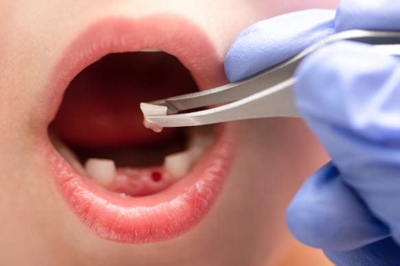 How Long Does A Loose Tooth Take To Fall Out In Adults