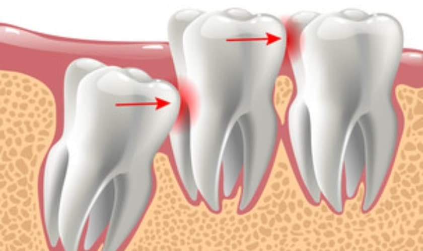 How Long Does It Take For A Wisdom Tooth To Emerge