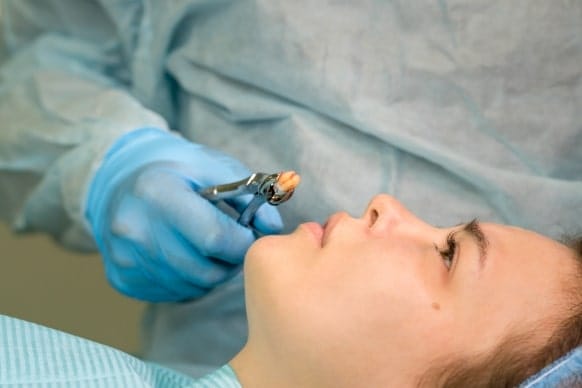 How Long Should You Wait To Exercise After Tooth Extraction