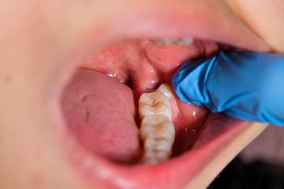 Close-Up Of An Open Mouth Showing A Wisdom Tooth With A Gloved Finger Examining The Area, Depicting Wisdom Tooth Pain And Relief Methods.