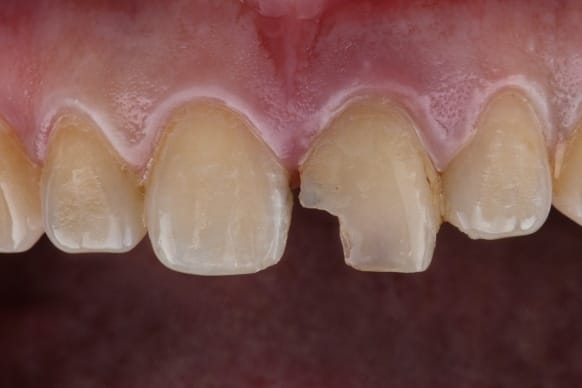 How Much Does It Cost To Repair A Chipped Tooth