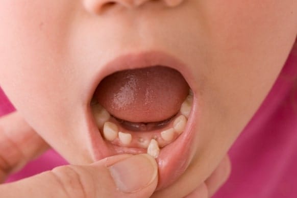How To Deal With A Loose Front Tooth