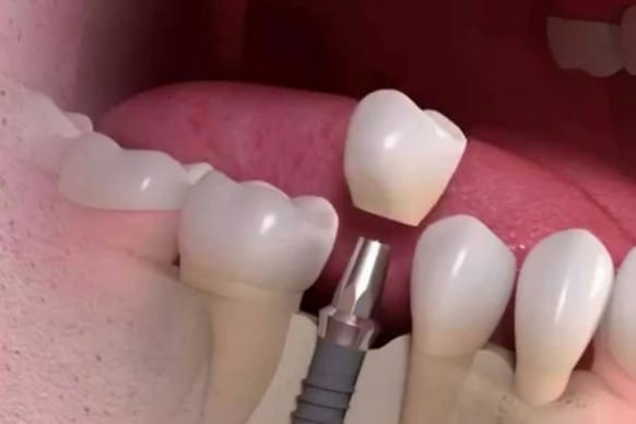 Why Is My Implant Failing And What Can I Do