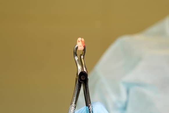 Importance Of Avoiding Ibuprofen After Tooth Extraction