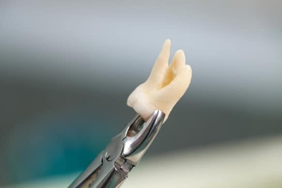 Importance Of Post Tooth Extraction Antibiotics