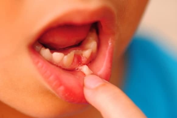 Simple Methods To Extract A Loose Tooth Safely At Home