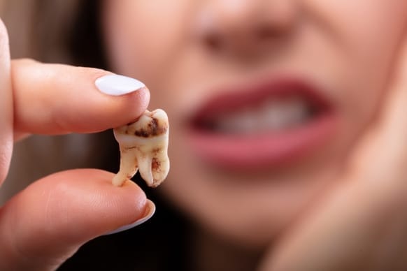 Close-Up Of A Person Holding A Removed Wisdom Tooth With Decay Spots, Showcasing Dental Health Issues Related To Wisdom Teeth. The Background Shows A Blurred Expression Of Discomfort, Highlighting The Pain Often Associated With Wisdom Tooth Problems.