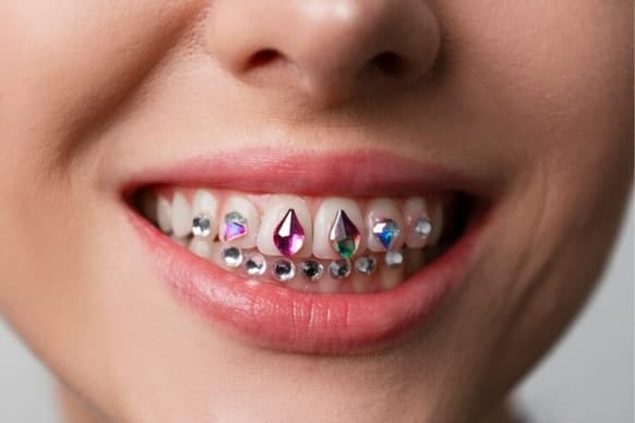 Steps For Safely Removing Tooth Gems