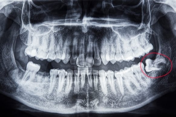 Tips For Fast Recovery After Wisdom Teeth Surgery