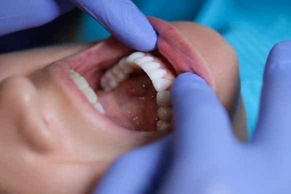 What Is Tooth Bonding