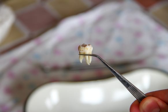 When Can I Safely Smoke After Tooth Extraction