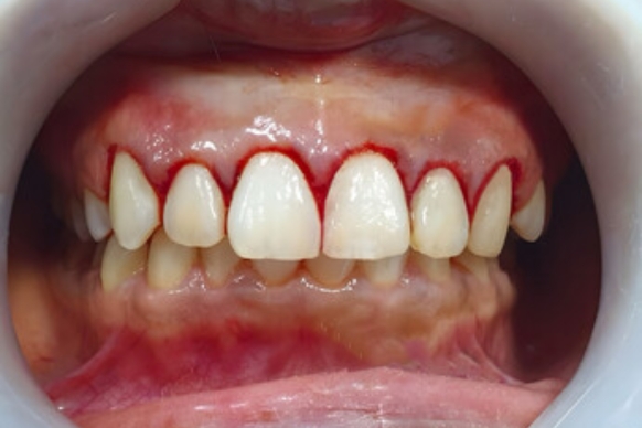 Common Oral Infections