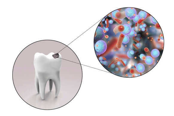 Natural Ways To Kill Mouth Bacteria