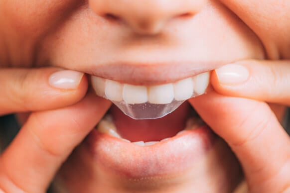 Should I Brush My Teeth After Whitening Strips