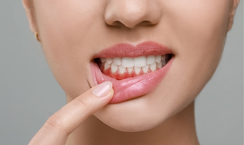 Rid Of Swollen Gums