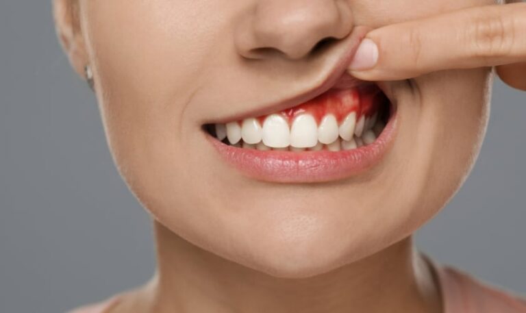 Gum Disease Severity