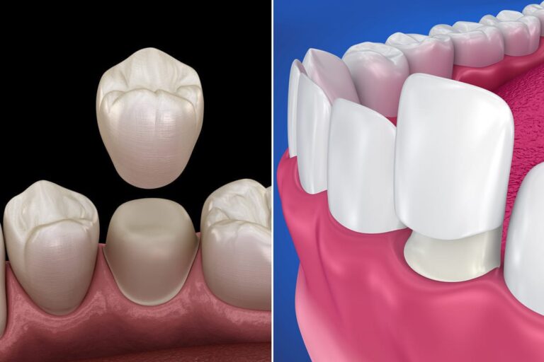 Img Crown Vs Veneers