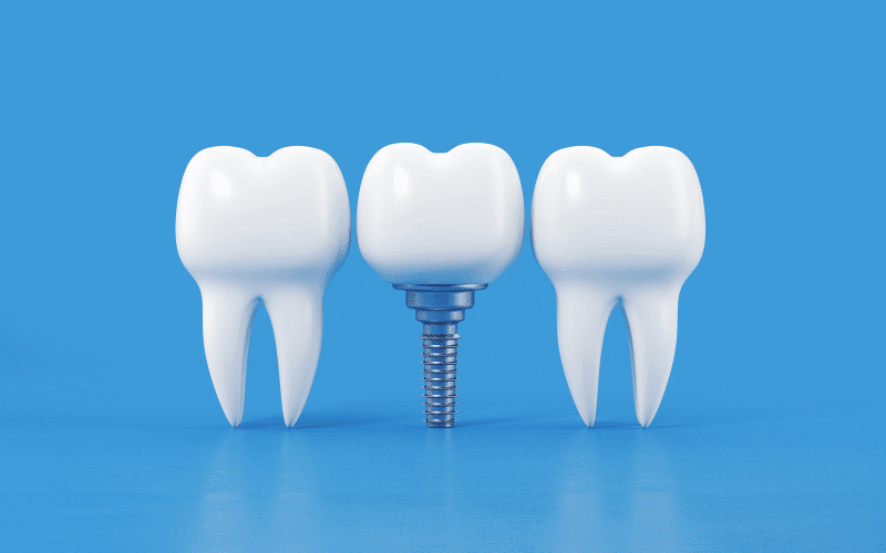 Benefits Of Dental Implants