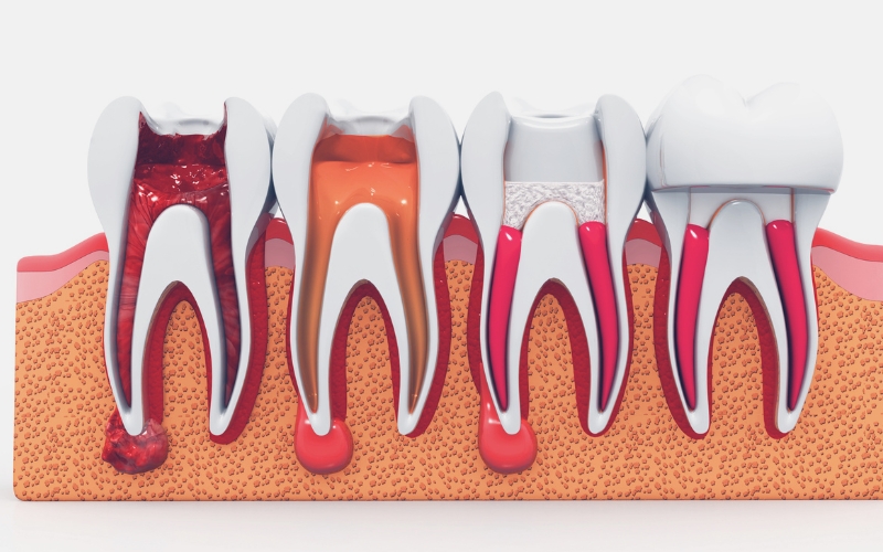 What Should I Expect From A Root Canal 1