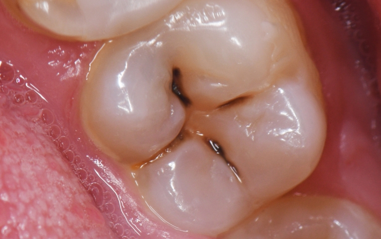 What Causes Cavities And How You Can Prevent Them?