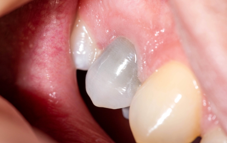 Does A “Dead Tooth” Mean That I Need A Root Canal Treatment?
