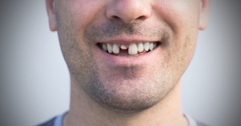 My Tooth Is Knocked Out