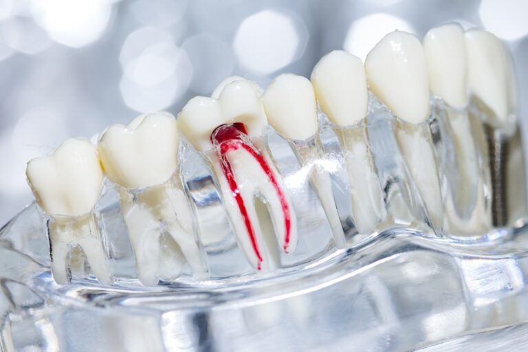 Root-Canal-Therapy-In-Cypress